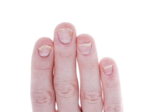 Risposte di psoriasi di Ayurveda