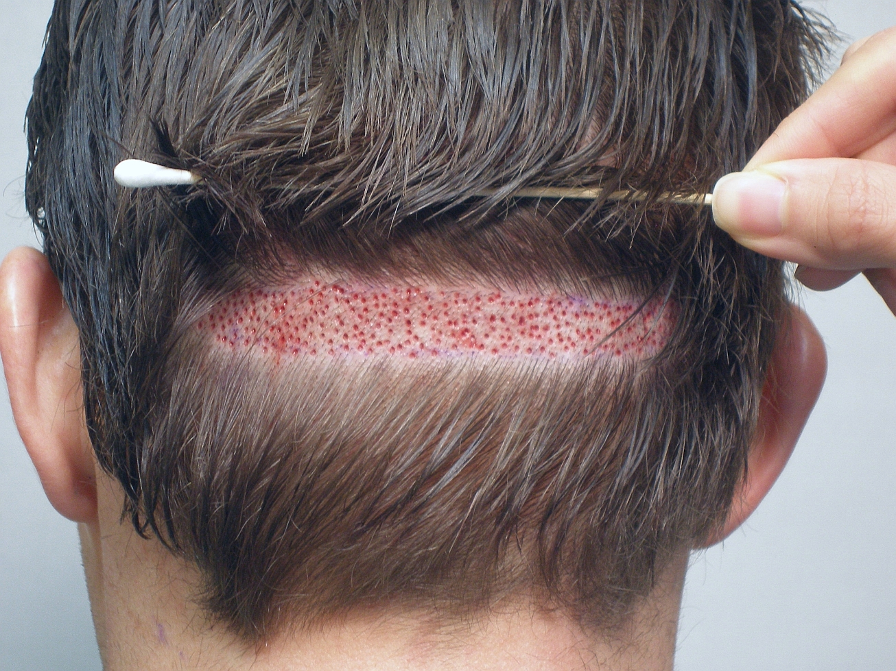 trapianto di capelli CapelliStyle