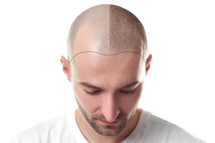 trapianto di capelli trapianto di capelli