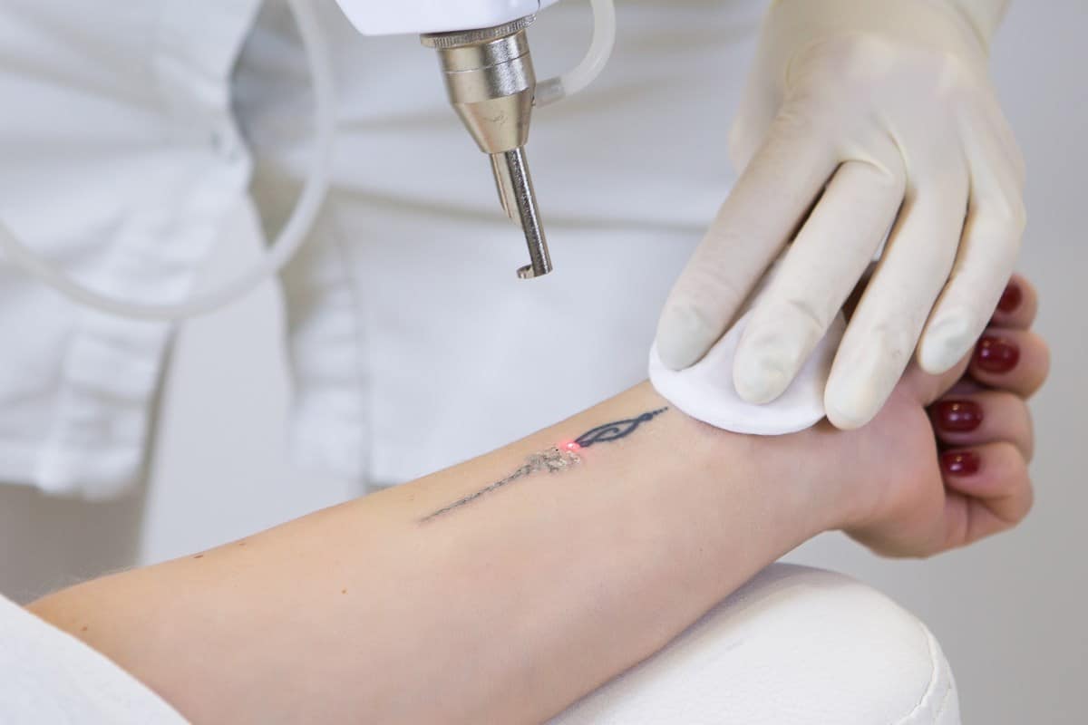 tatuaggi laser