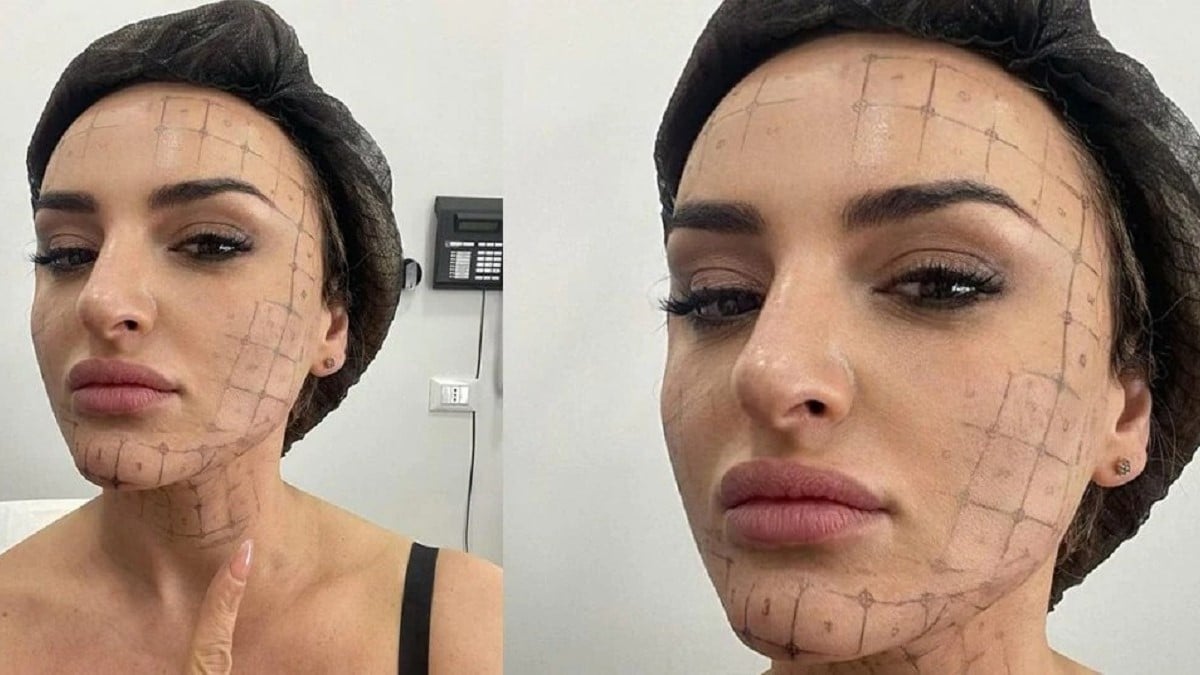 arisa look pelle trattamento thermage