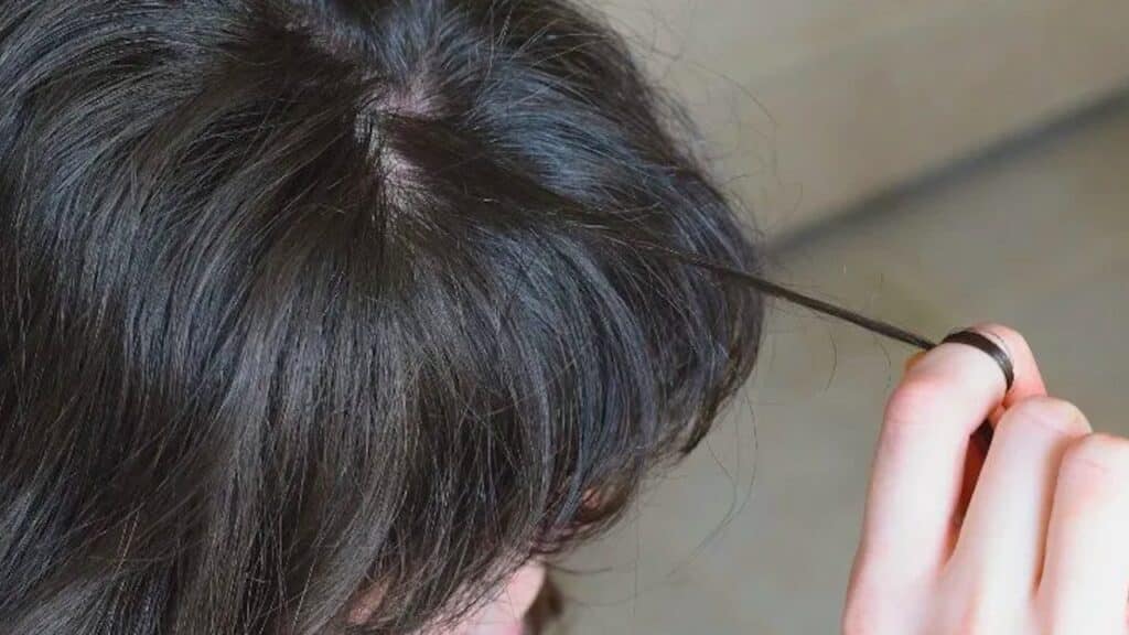 tricotillomania cosa è arisa