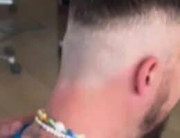 francesco facchinetti trapianto patch