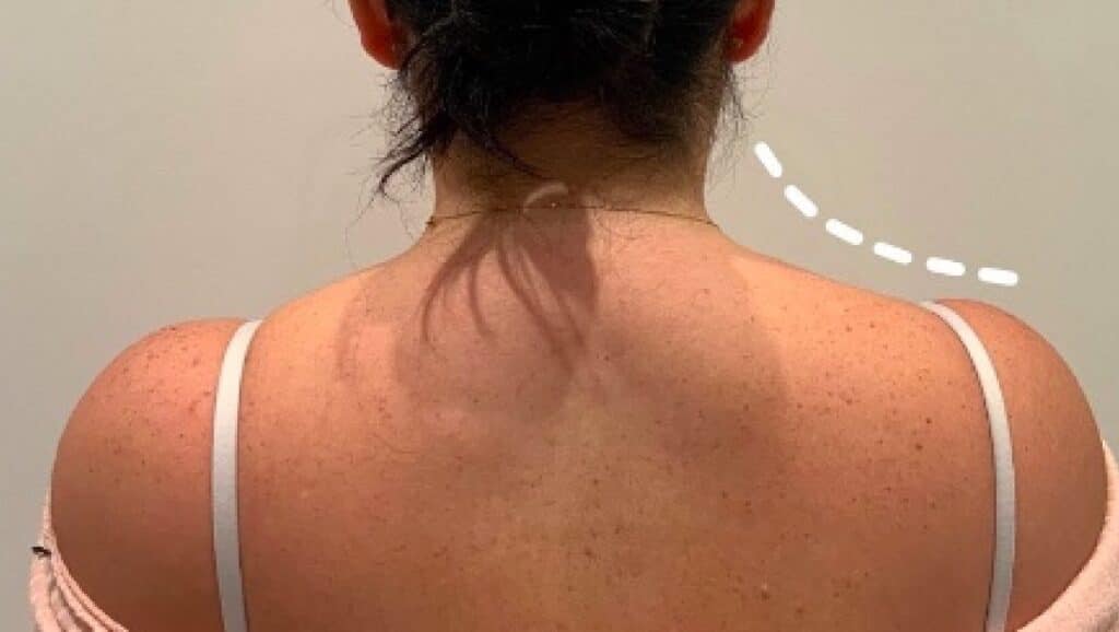 Trapezio botox: cosa sapere, benefici, prima e dopo
