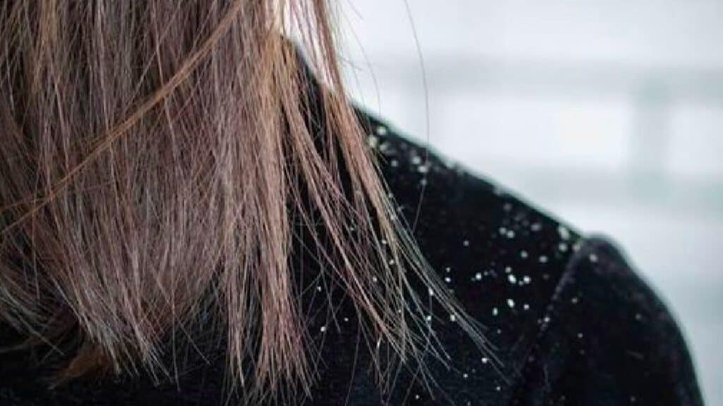 Attenzione allo shampoo, alcuni causano forfora e capelli grassi: "Ecco le 3 sigle da evitare"