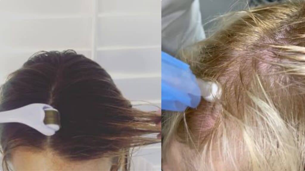 Fare microneedling sul cuoio capelluto dà uno stop alla caduta dei capelli?