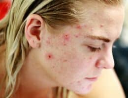 Pelle danneggiata con brufoli sul viso