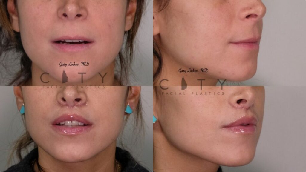 Lip lift cos'è e quanto costa: valida alternativa al botox