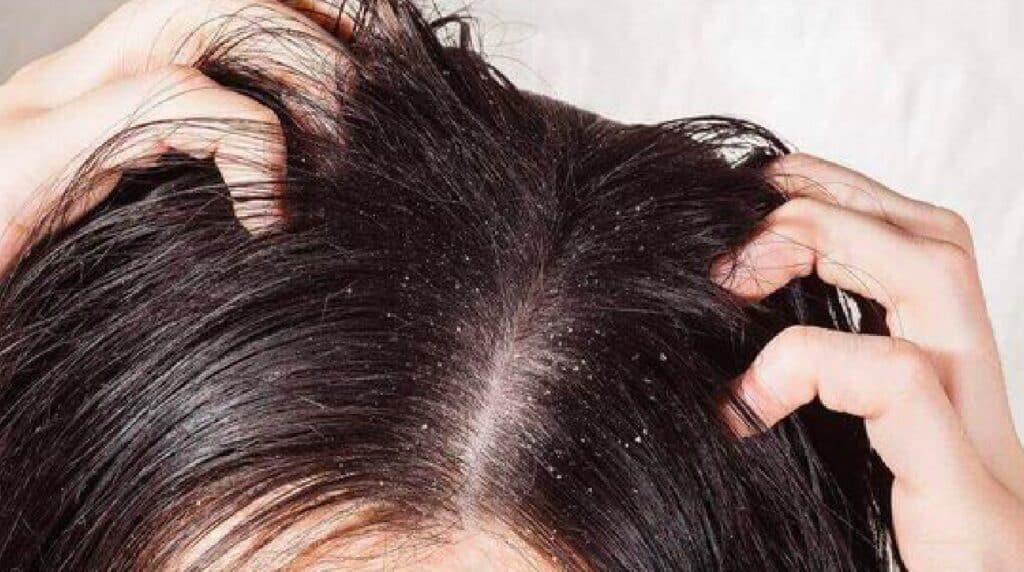 Sai cos'è la tinea capitis? Quando preoccuparsi seriamente del cuoio capelluto che prude