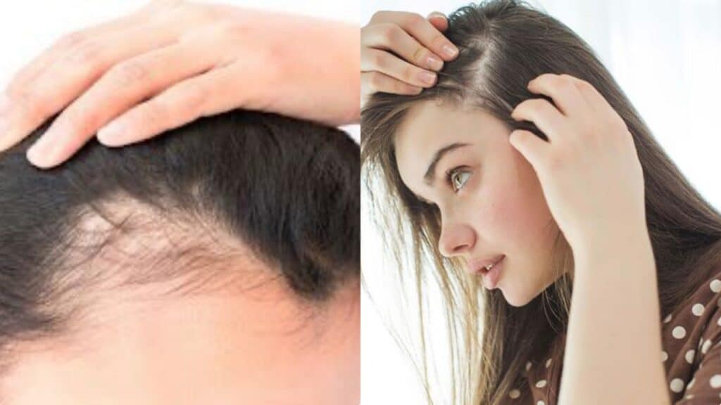 Trapianto dei capelli in Italia: costi e benefici