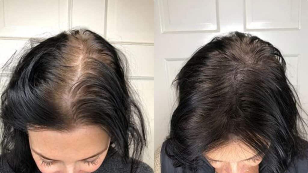 Tatuaggio dei capelli al posto del trapianto: cos'è la tricopigmentazione