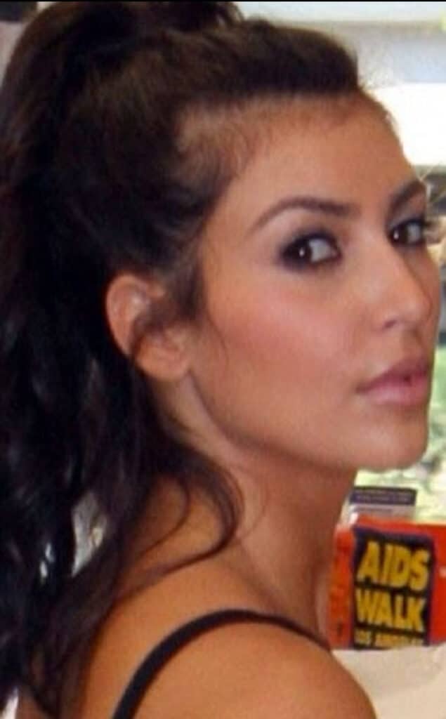 hairline laser removal