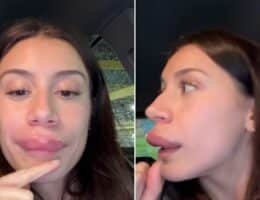 sandra-gonzalez-filler-labbra enormi