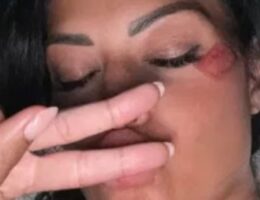 volto canale 5 incidente investita