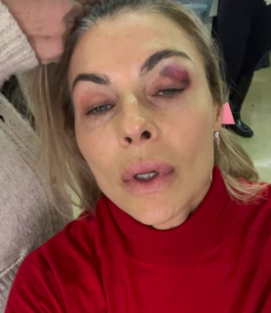 martina-colombari-occhio-nero