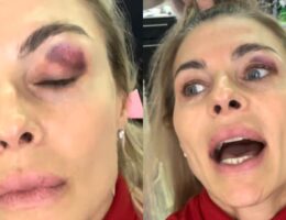 martina-colombari-occhio-nero